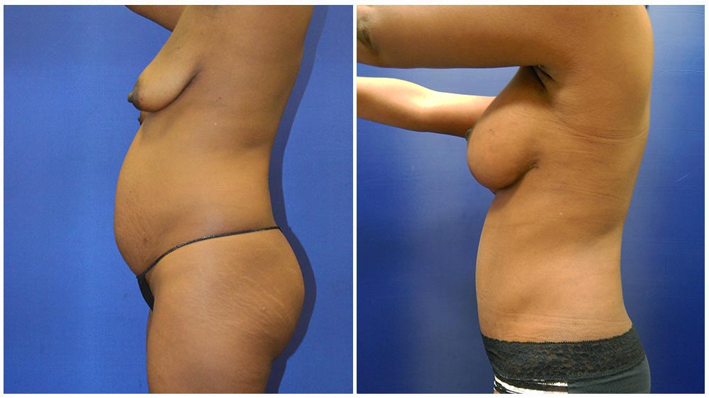 1breast2